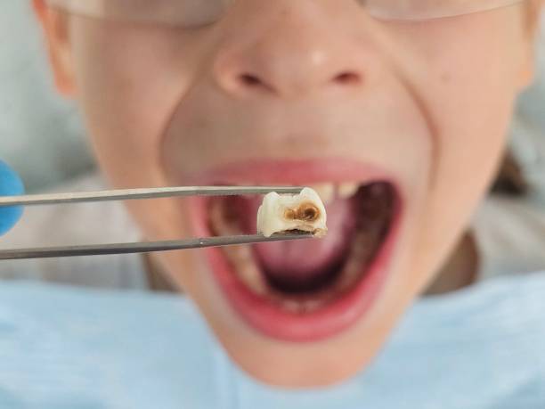 Best Pediatric Emergency Dentist in Sutherlin, OR